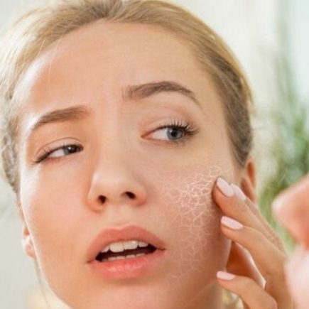 cara menghilangkan kulit kering di wajah